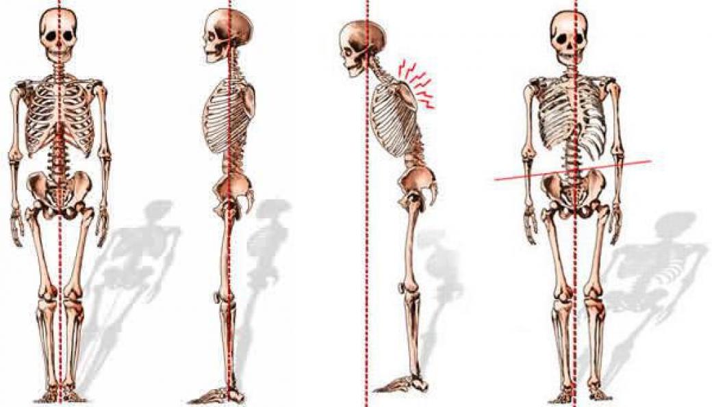 Adult Spinal Deformities Diagnosis Treatment NYC Columbia adult-spinal-deformities-diagnosis-treatment-nyc-columbia