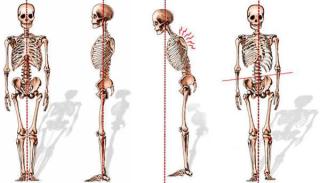 Adult Spinal Deformities Diagnosis & Treatment - NYC | Columbia ...