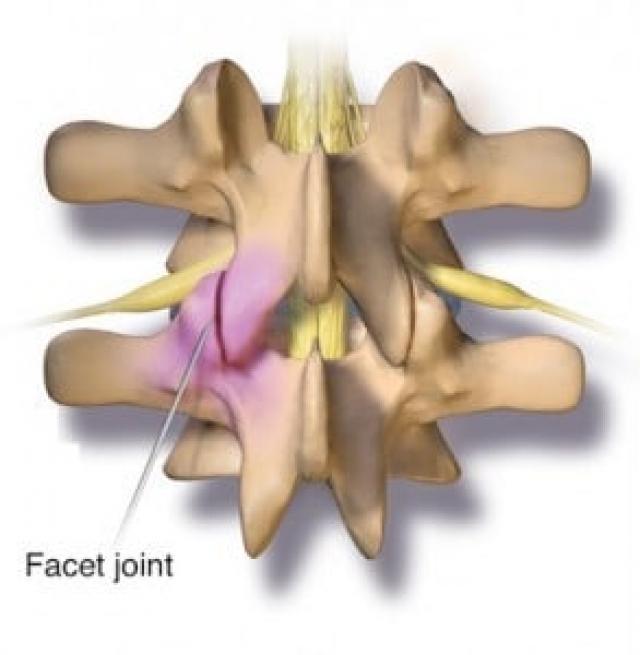 Synovial Cyst Diagnosis & Treatment NYC Columbia Neurosurgery in